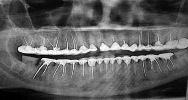 leczenie kanałowe niemal wszystkich zębów