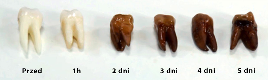 Zęby wystawione na działanie popularnego słodkiego gazowanego napoju