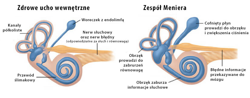 anatomia ucha w chorobie Meniera